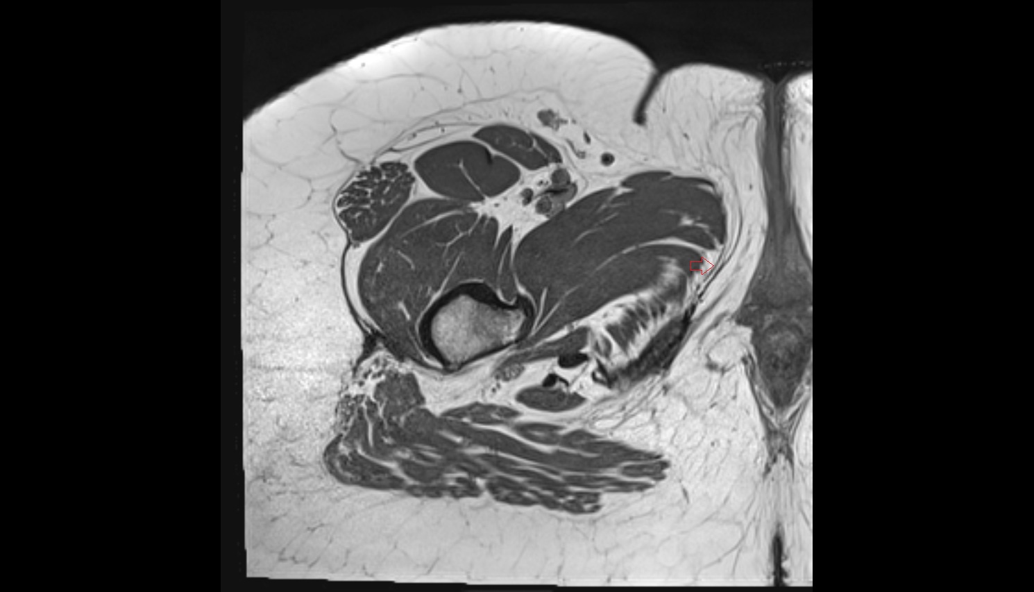 Gracilis Tendon (Proximal)  MRI AXIAL anatomy image-img-1