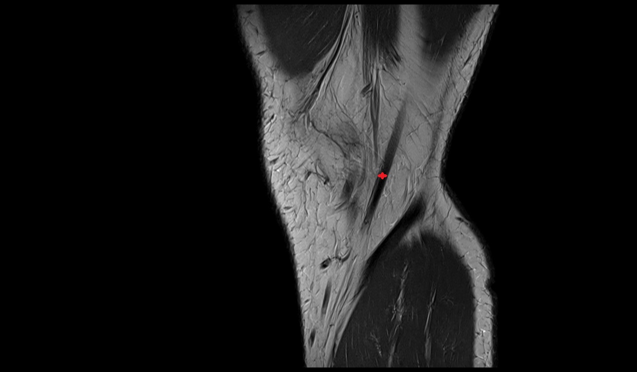 Gracilis Tendon anatomy image