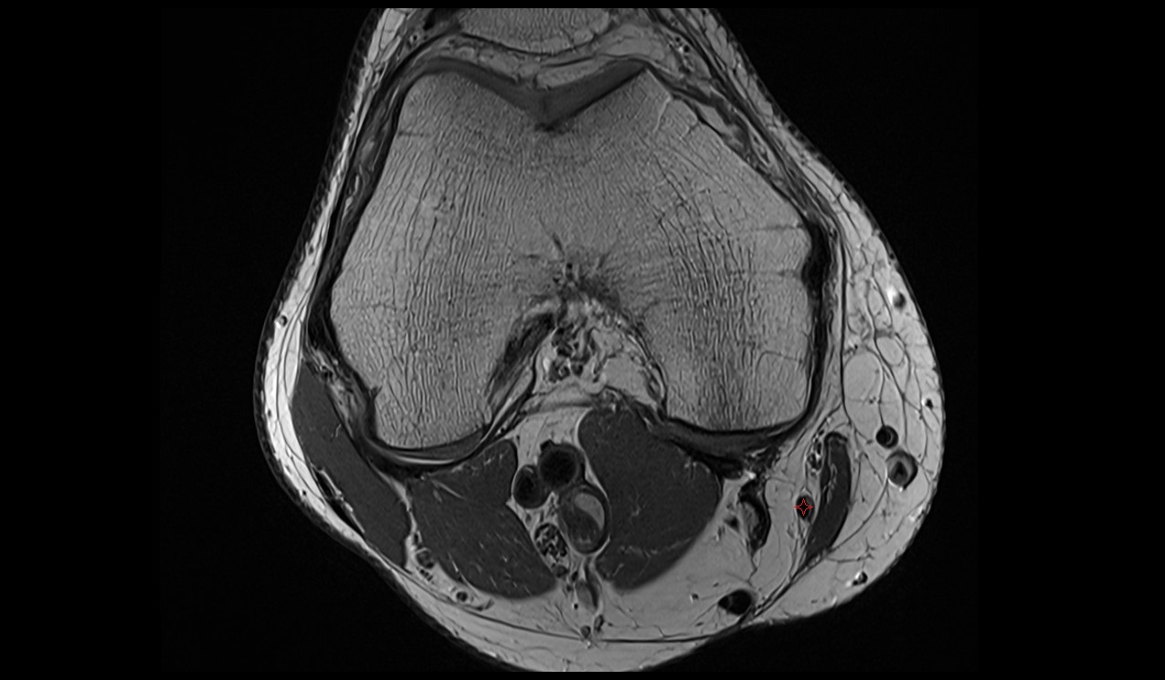 Gracilis Tendon anatomy image mri 3t