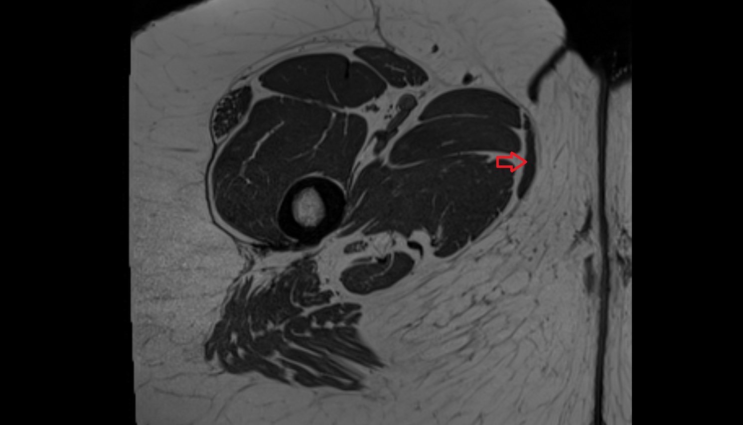 Gracilis muscle  MRI  axial  anatomy  image-img-00000-00000