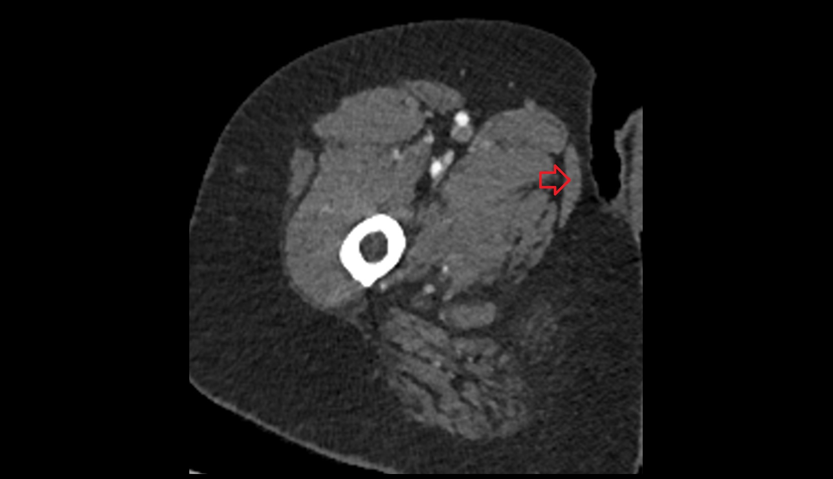 Gracilis muscle axial ct image 1