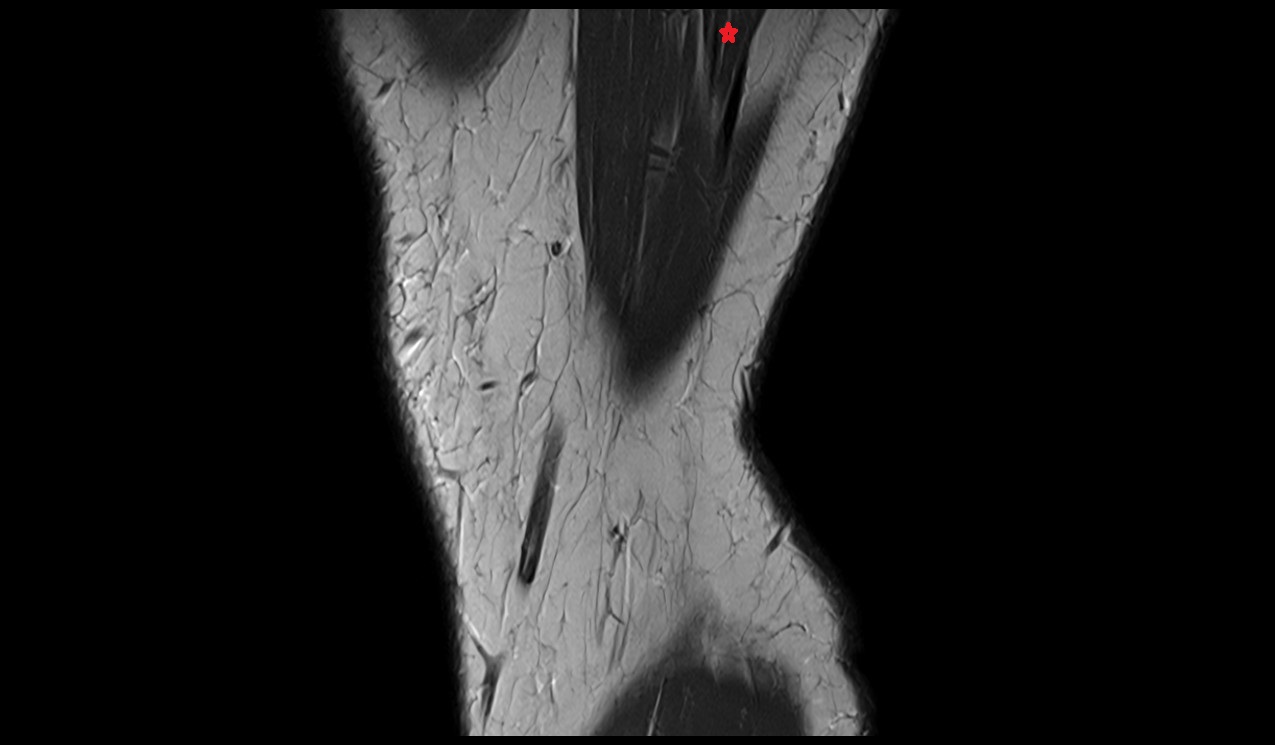 Gracilis muscle mri image