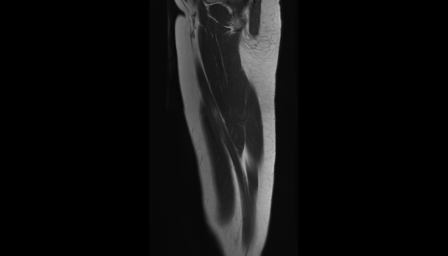 Gracilis muscle  sag  cross sectional anatomy 3T radiology  anatomy image-img-00000-00000