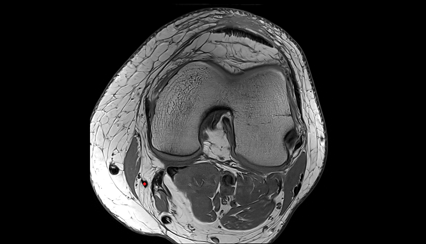 Gracilis tendon (Distal)  axial  cross sectional anatomy 3T MRI AI enhanced  radiology  anatomy image-img-00000-00000
