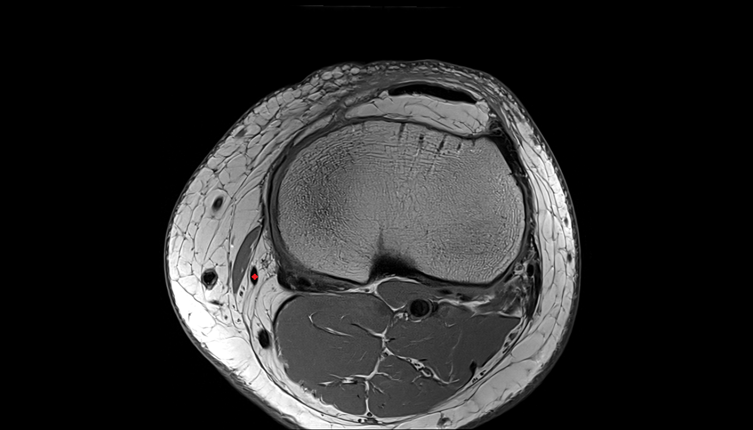 Gracilis tendon (Distal)  axial  cross sectional anatomy 3T MRI AI enhanced  radiology  anatomy image-img-00000-00000_00001