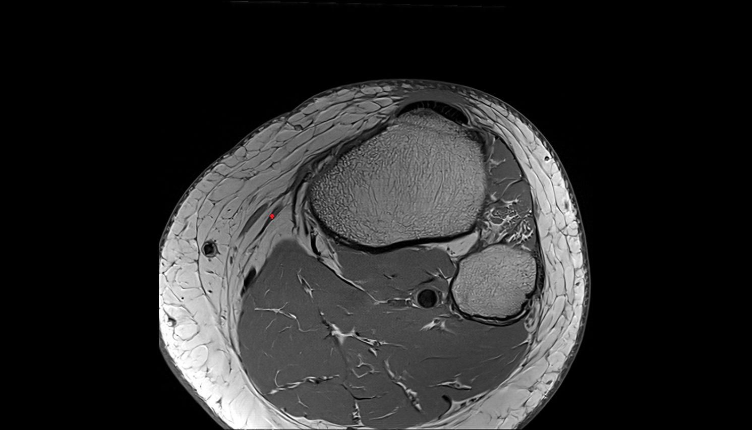 Gracilis tendon (Distal)  axial  cross sectional anatomy 3T MRI AI enhanced  radiology  anatomy image-img-00000-00000_00002