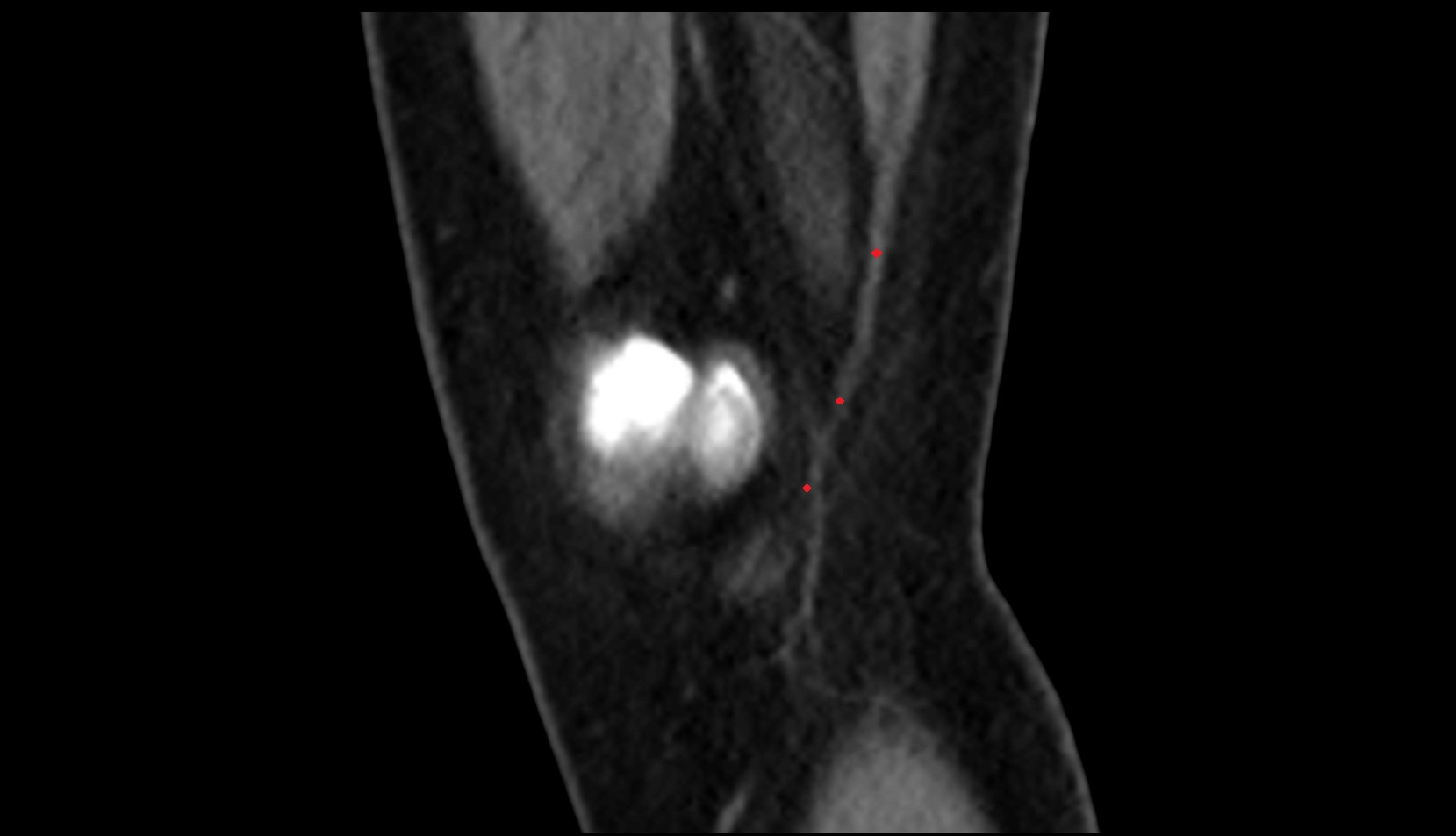 Gracilis tendon (Distal)  ct sagittal image