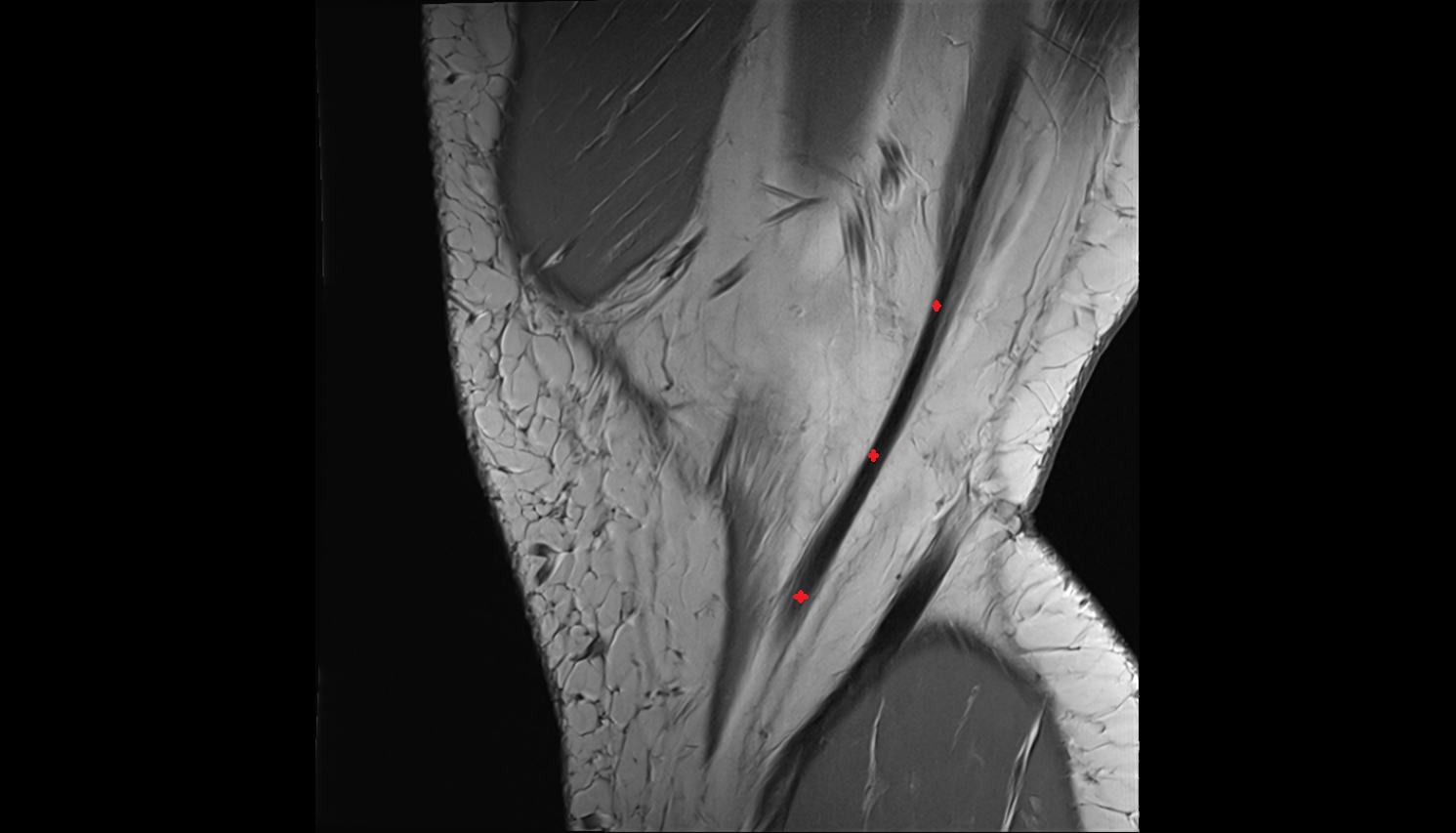 Gracilis tendon (Distal)  sagittal  cross sectional anatomy 3T MRI AI enhanced  radiology  anatomy image-img-00000-00000