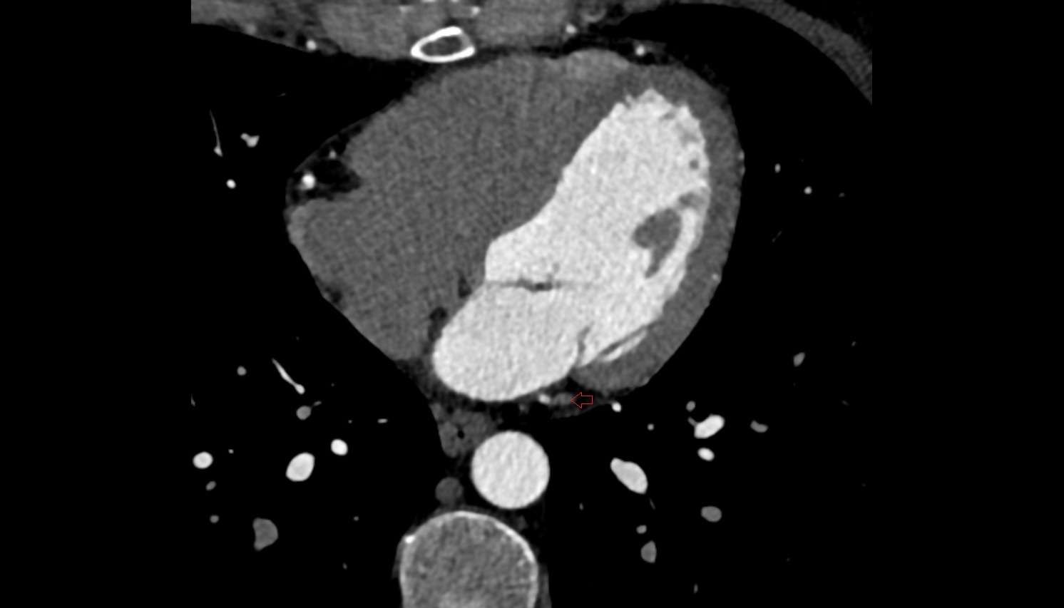 Great cardiac vein  CT  axial image -img-00000-00000