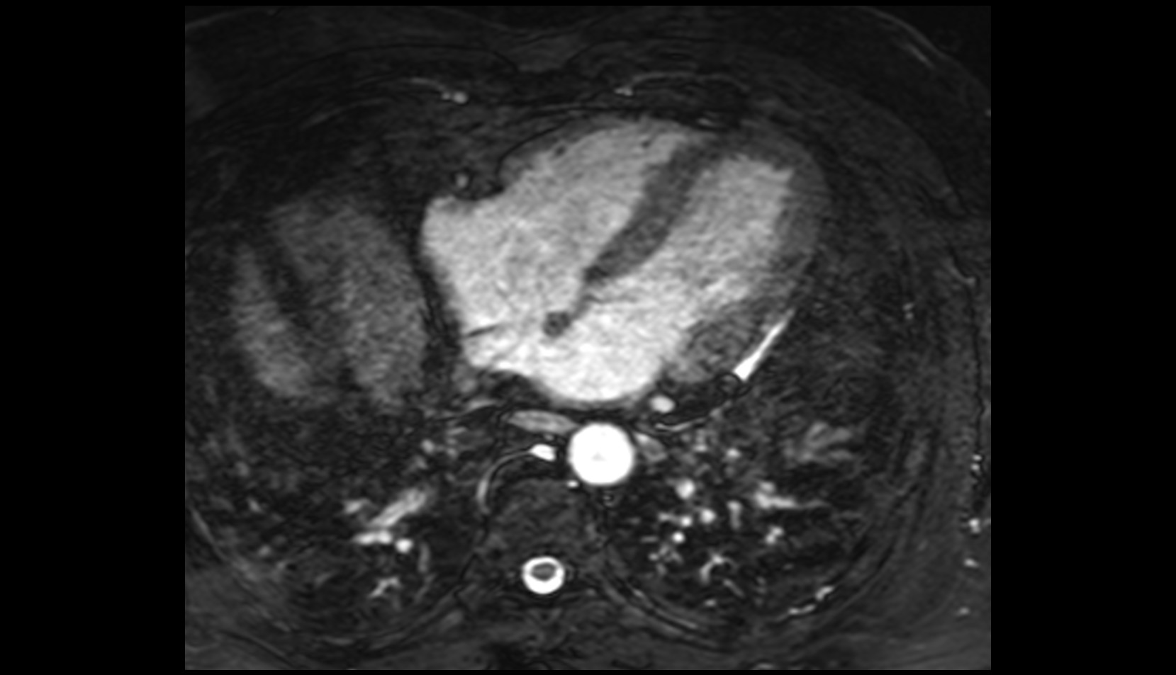 Great cardiac vein mri axial image