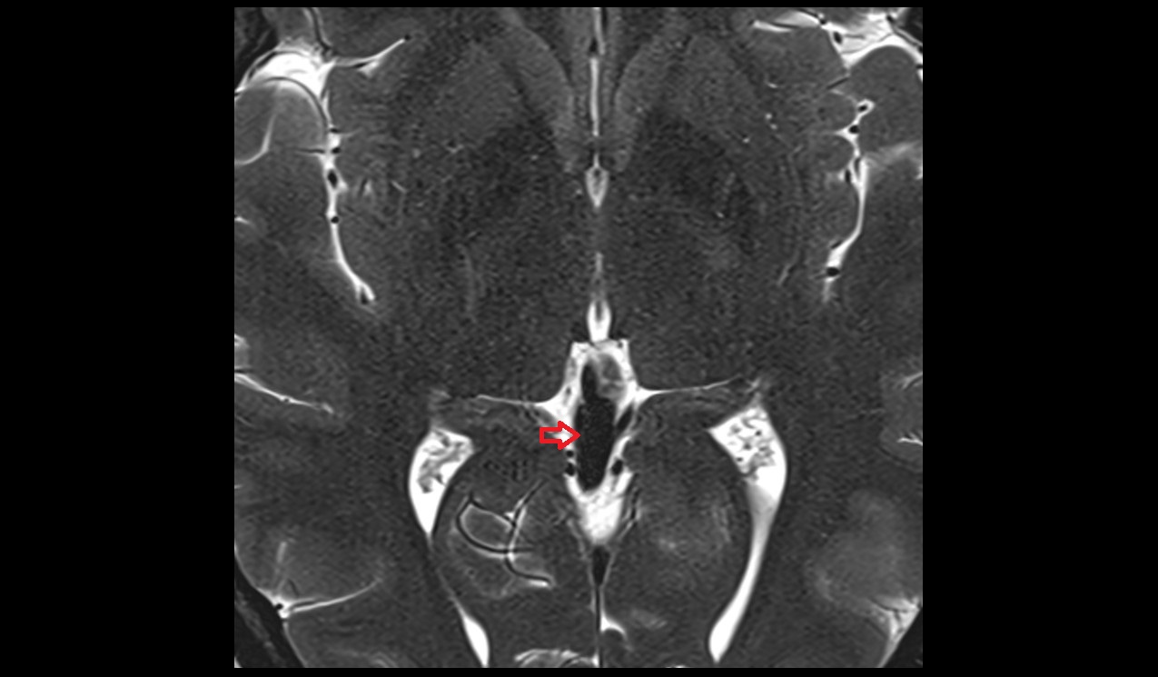Great cerebral vein (vein of Galen)  MRI 3T axial image