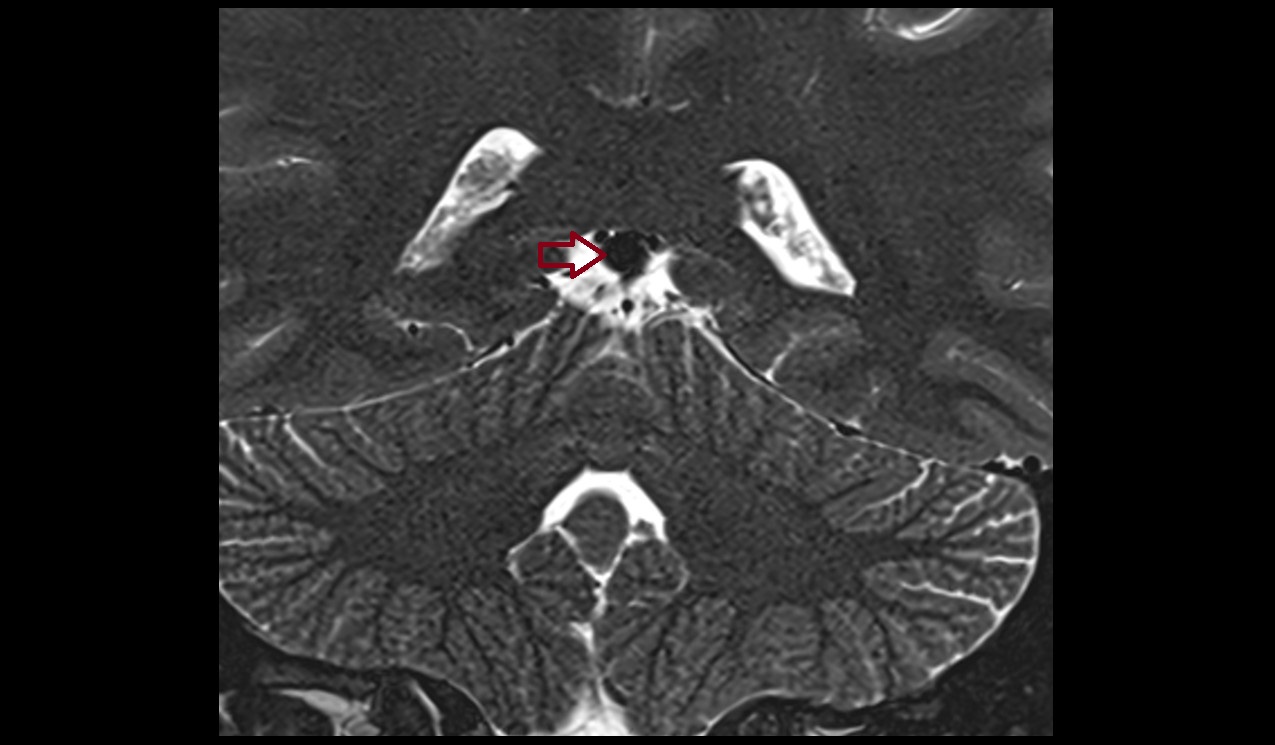 Great cerebral vein (vein of Galen)  MRI 3T coronal  image