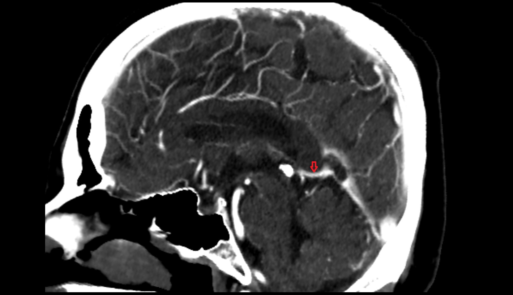 Great cerebral vein (vein of Galen)  MRI 3Tmip image