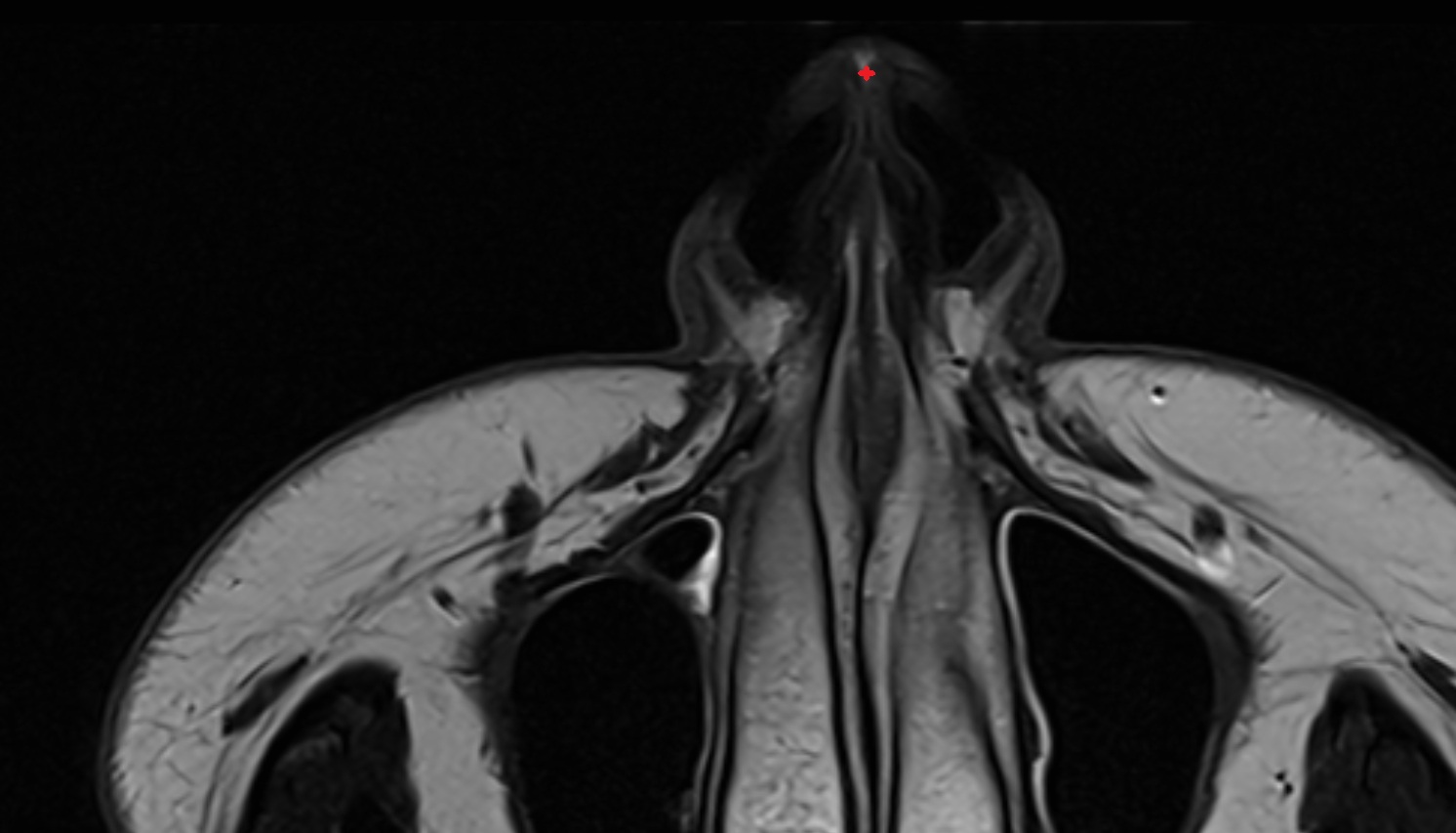 Greater alar cartilage  mri axial image -img-00000-00000