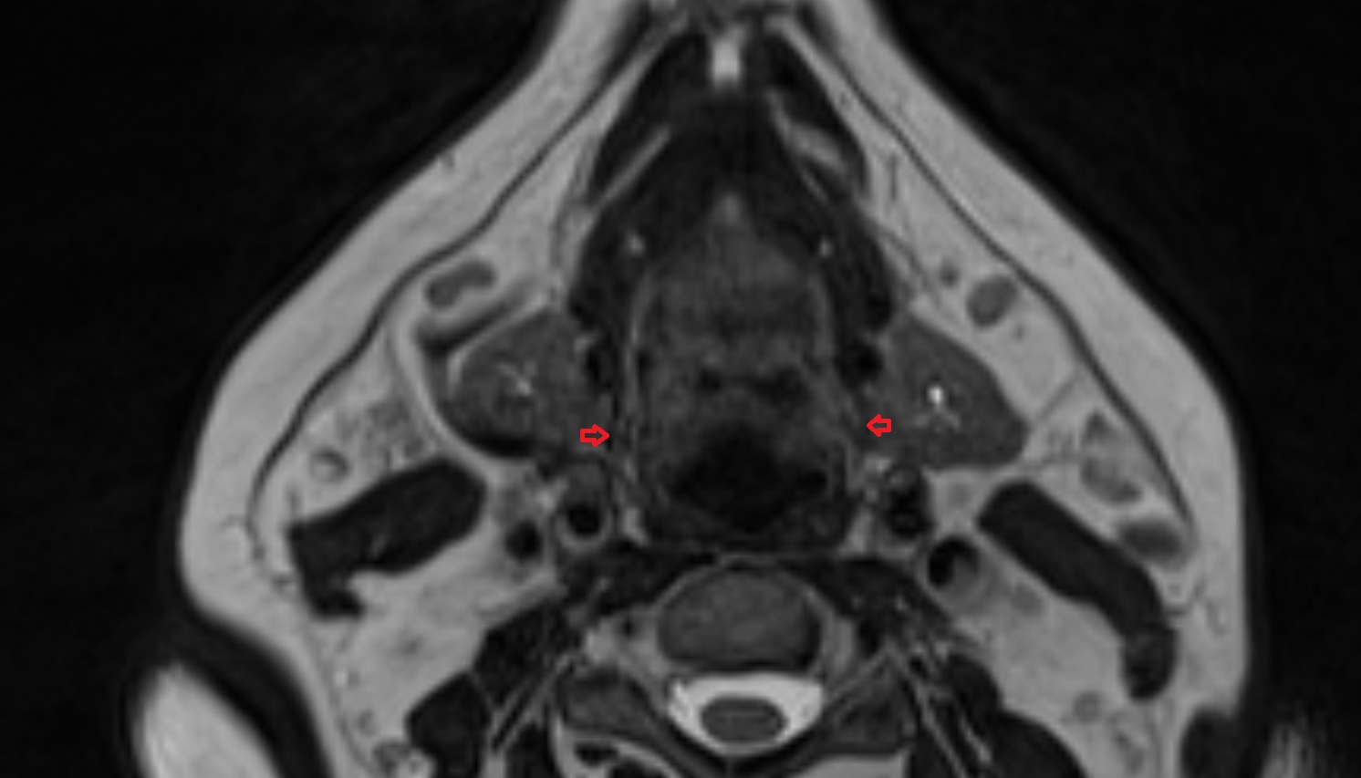 Greater horn of hyoid bone  mri sag  image -img-00000-00000