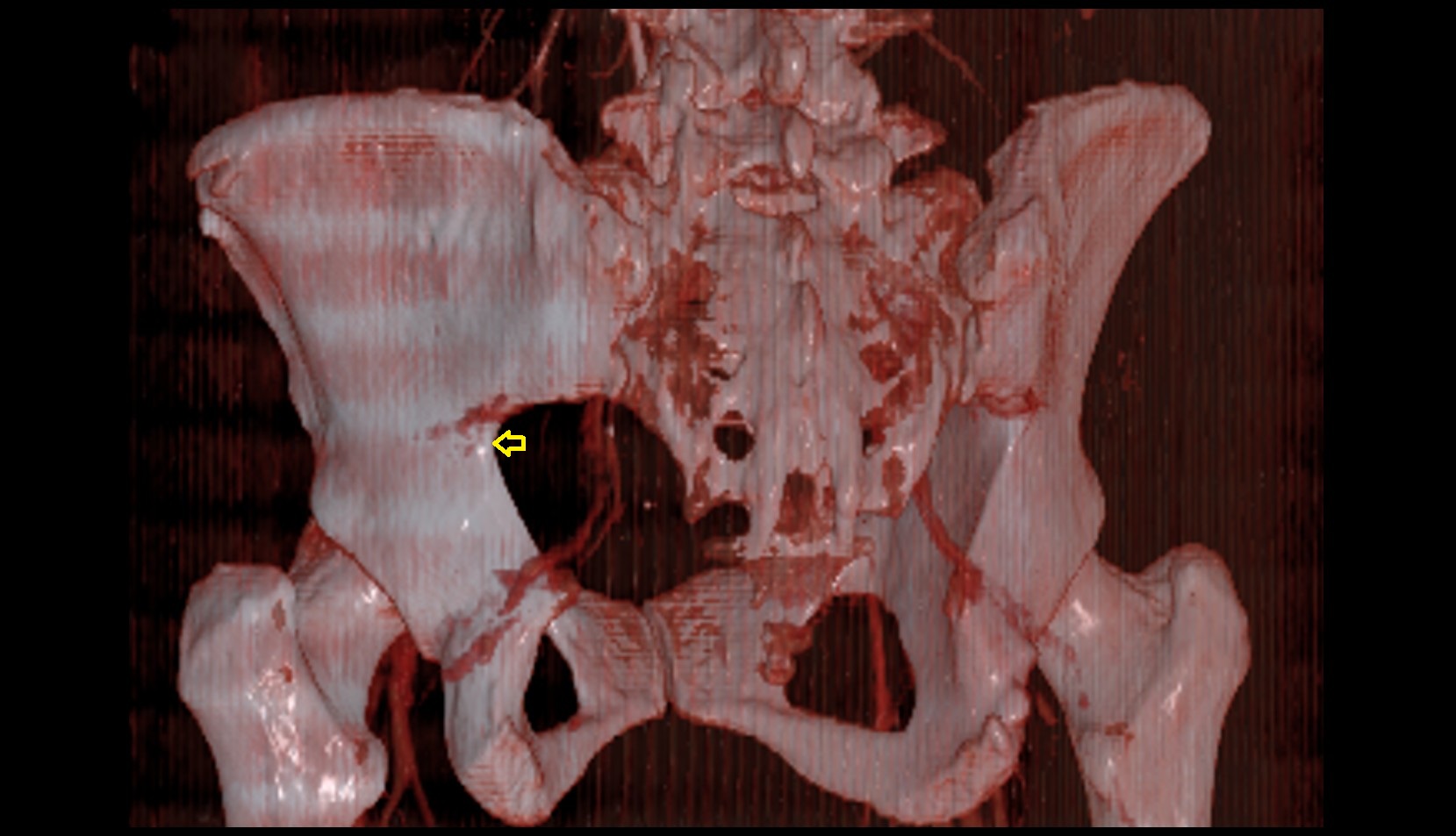 Greater sciatic notch 3D CT image