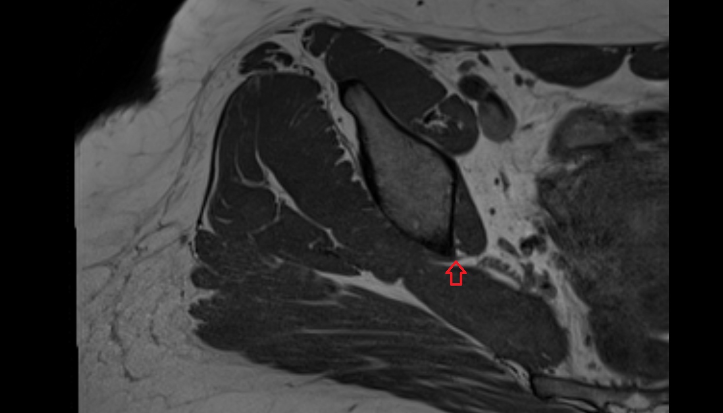 Greater sciatic notch  MRI  axial  anatomy  image-img-00000-00000