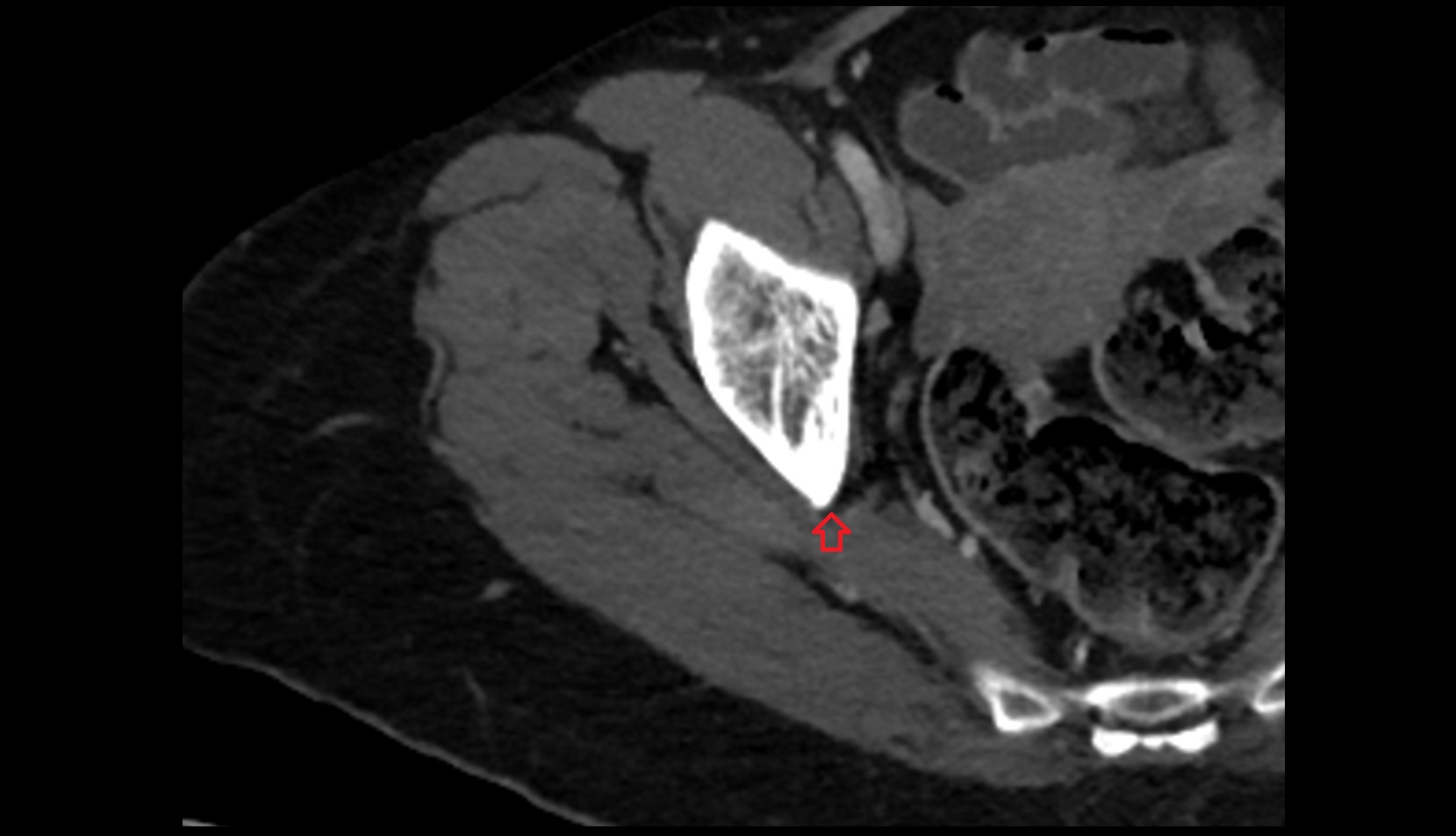 Greater sciatic notch ct axial image