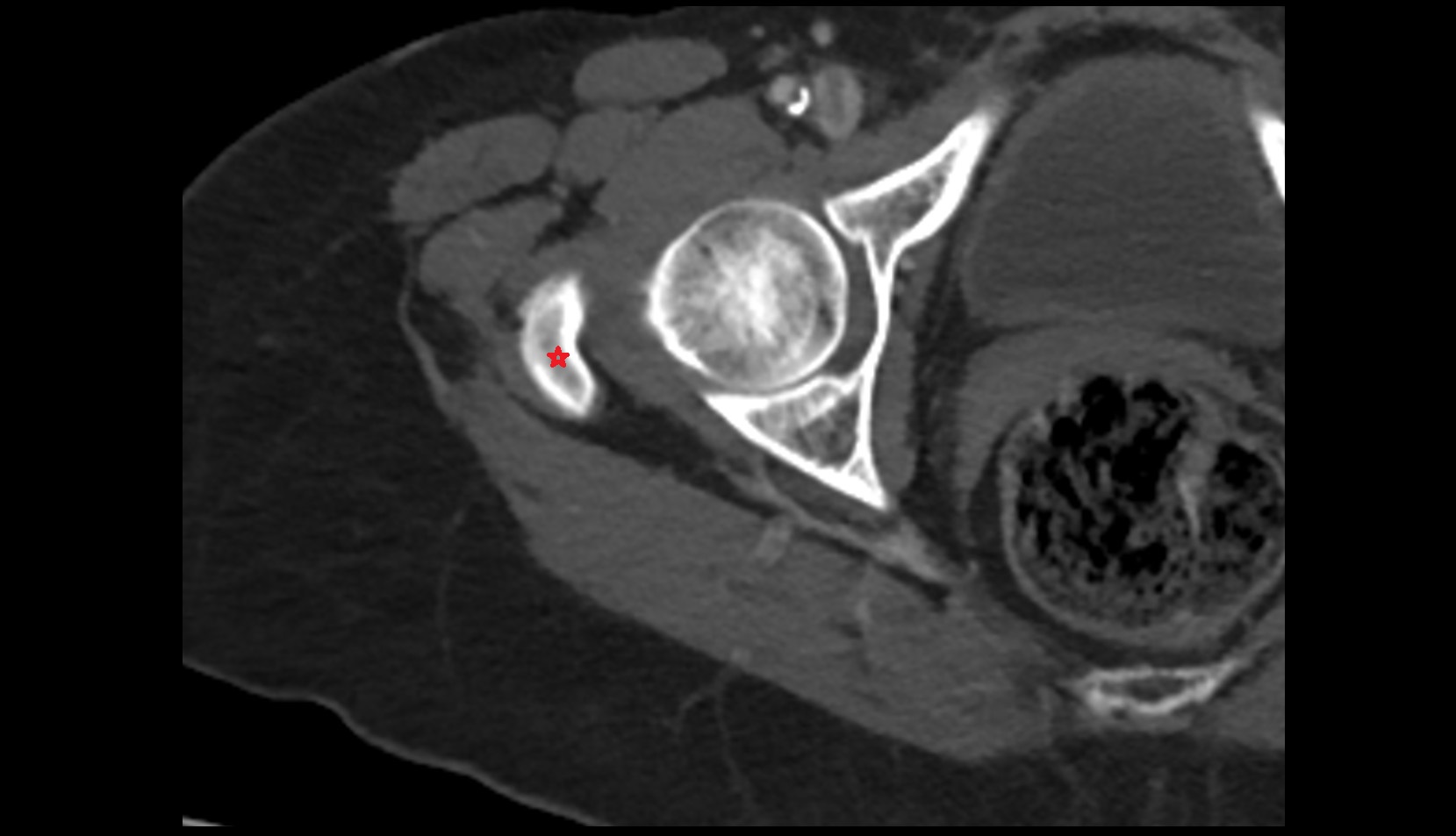 Greater trochanter CT axial image