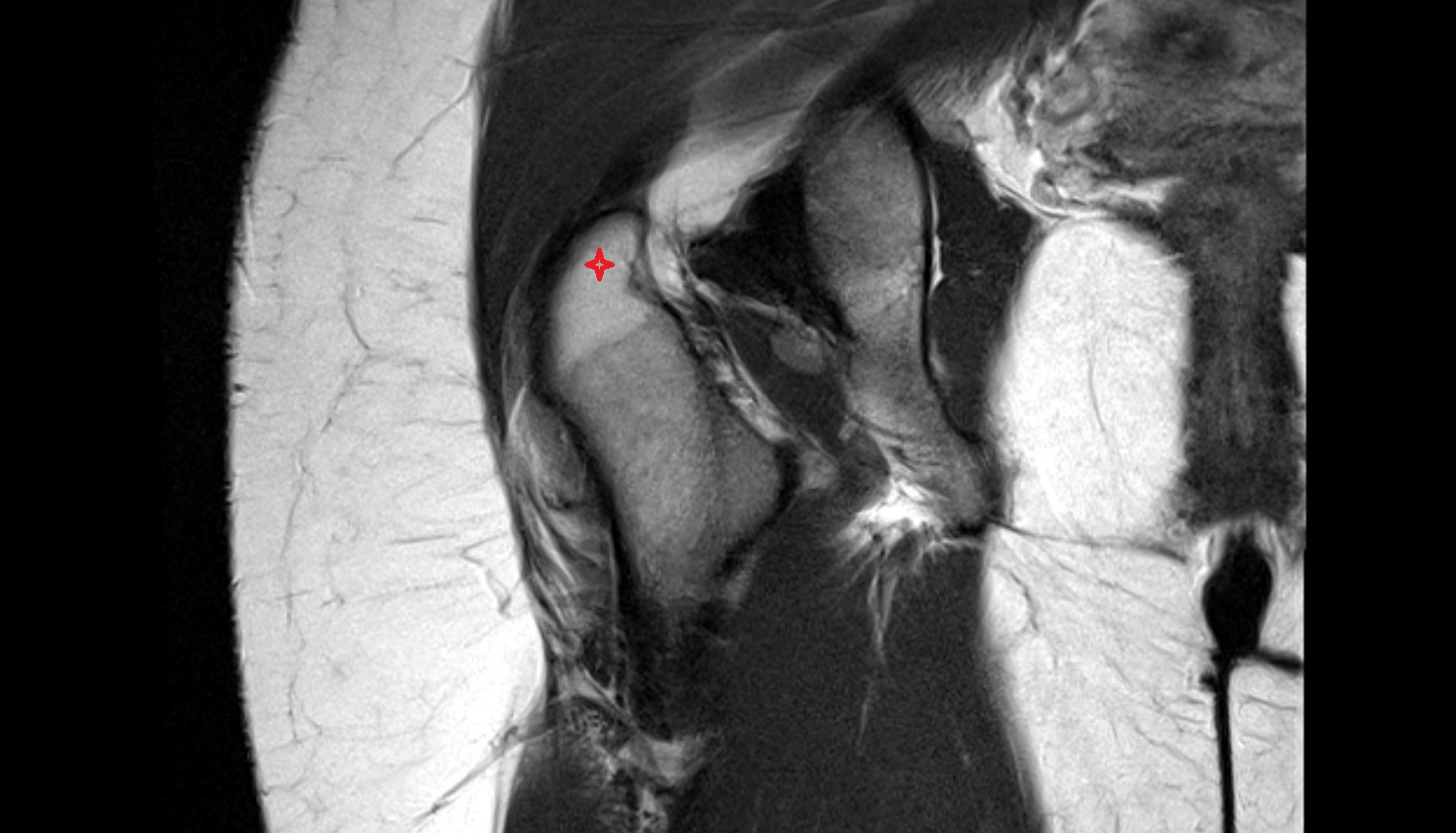 Greater trochanter  MRI CORONAL   anatomy image-img-00000-00000