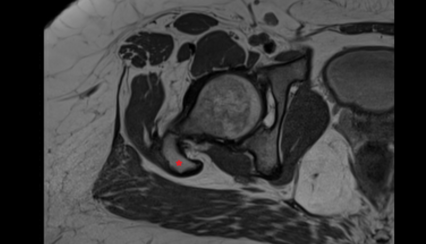 Greater trochanter  MRI  axial  anatomy  image-img-00000-00000