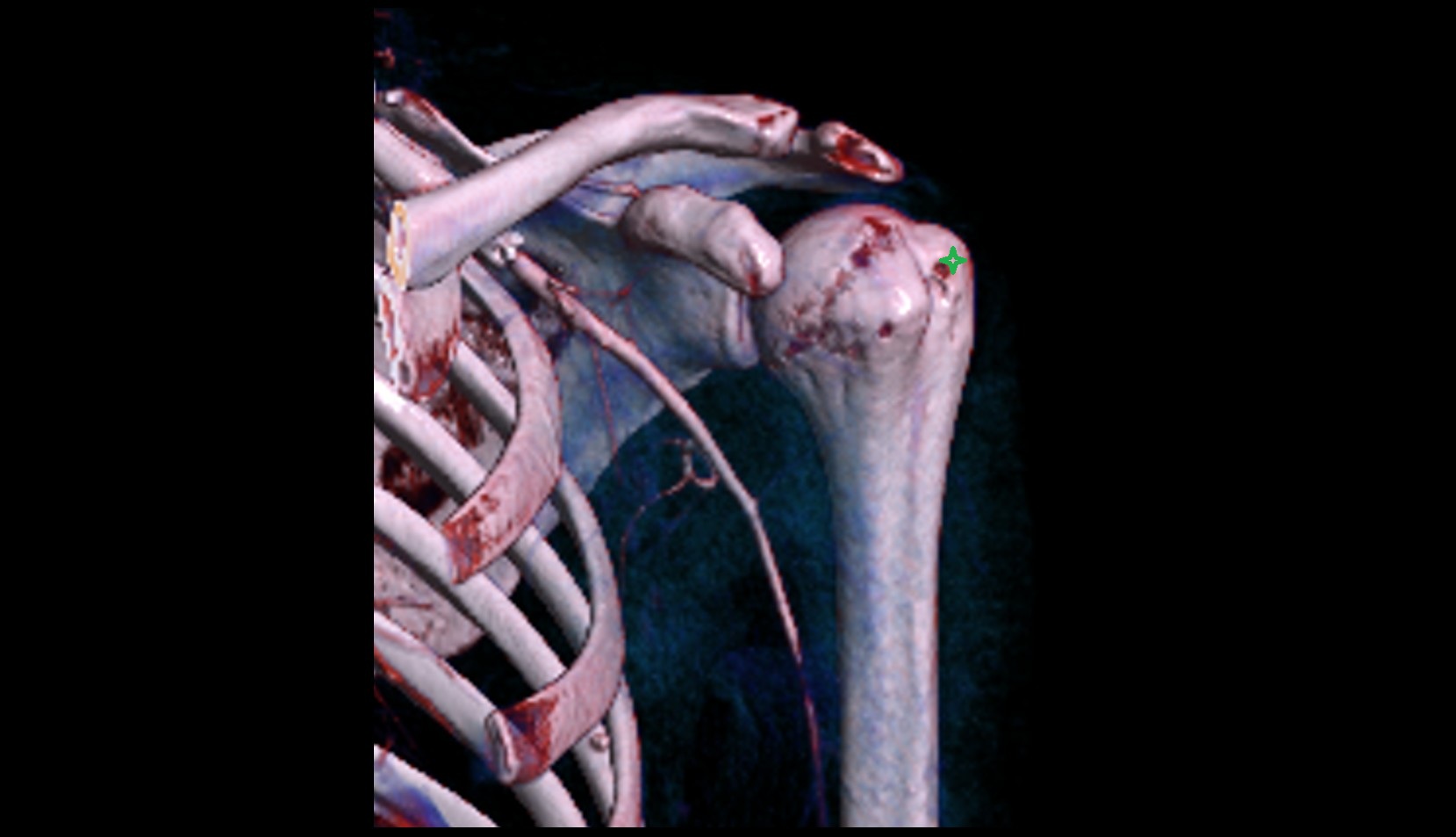 Greater tubercle of humerus 3d vrt image