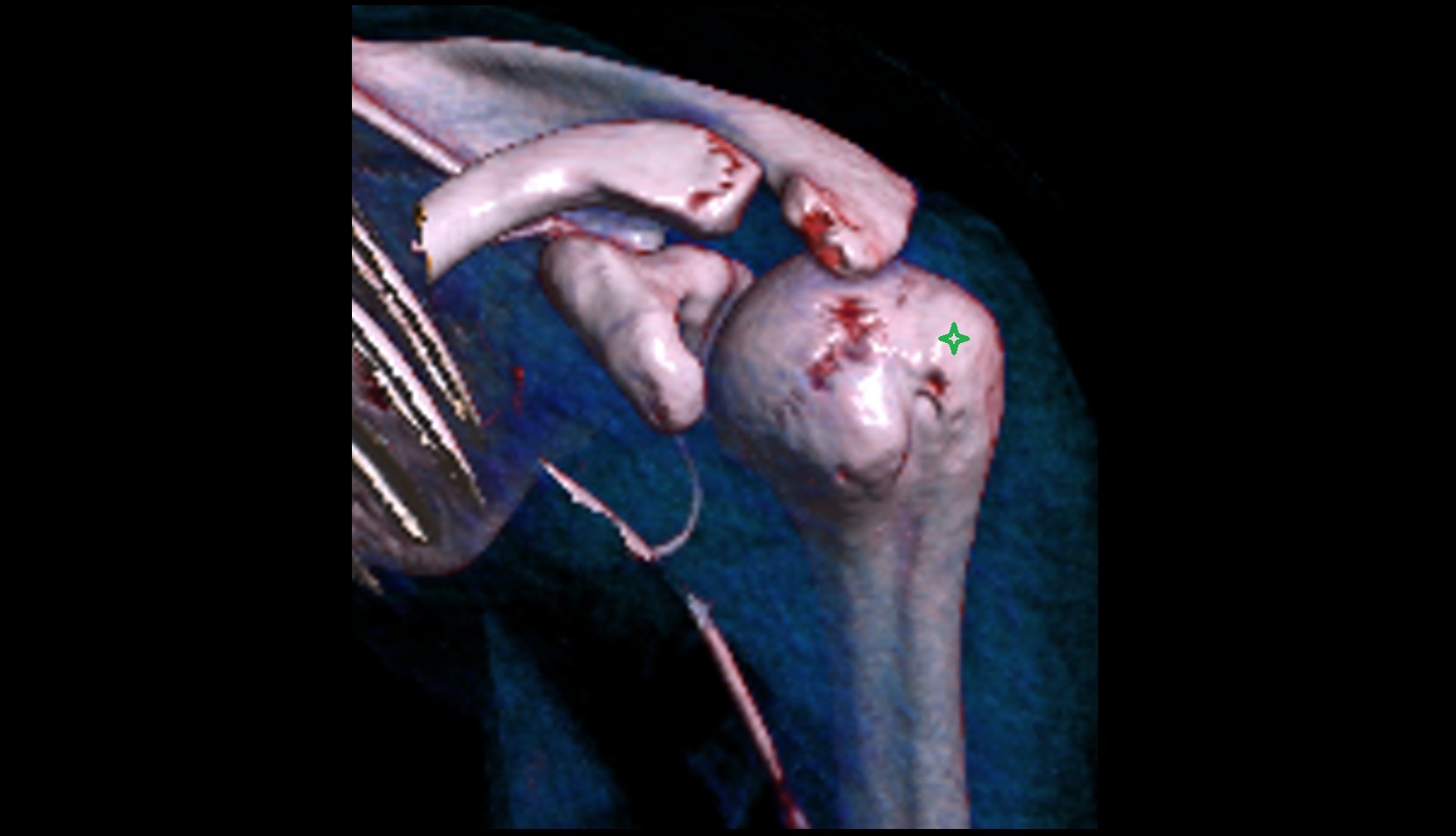 Greater tubercle of humerus 3d vrt image 1