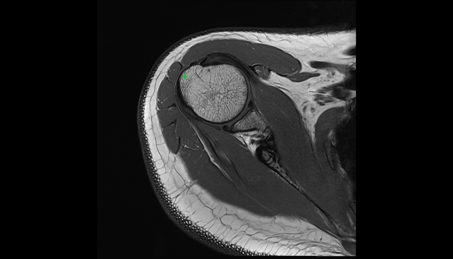 Greater tubercle of humerus  axial cross sectional anatomy 3T MRI AI enhanced radiology image-img-00000-00000