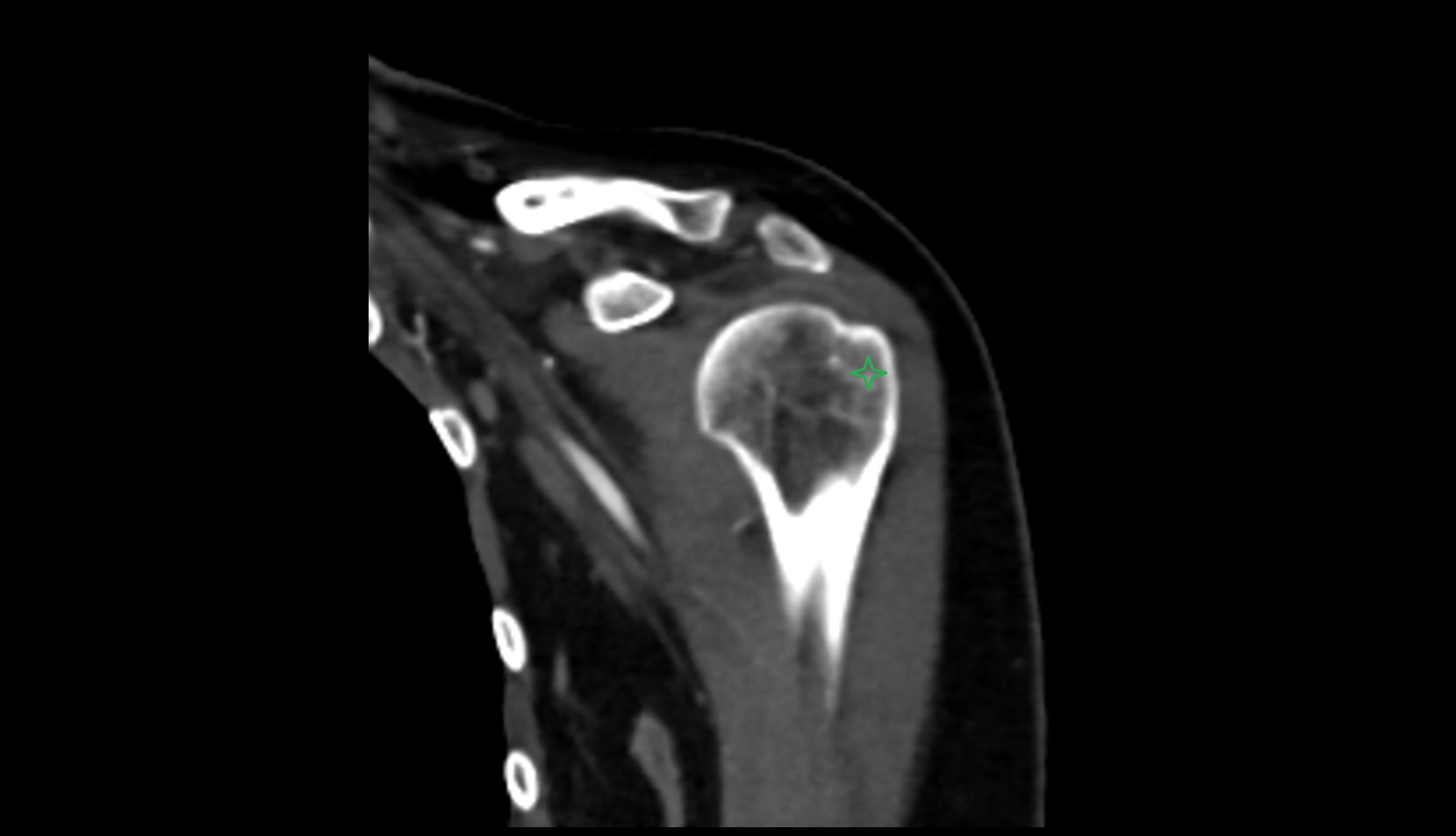 Greater tubercle of humeruscoronal ct image