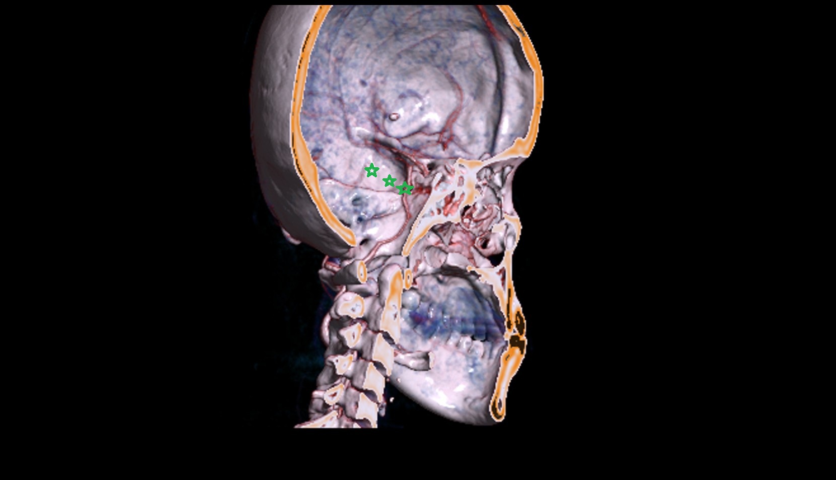 Greater wing of sphenoid