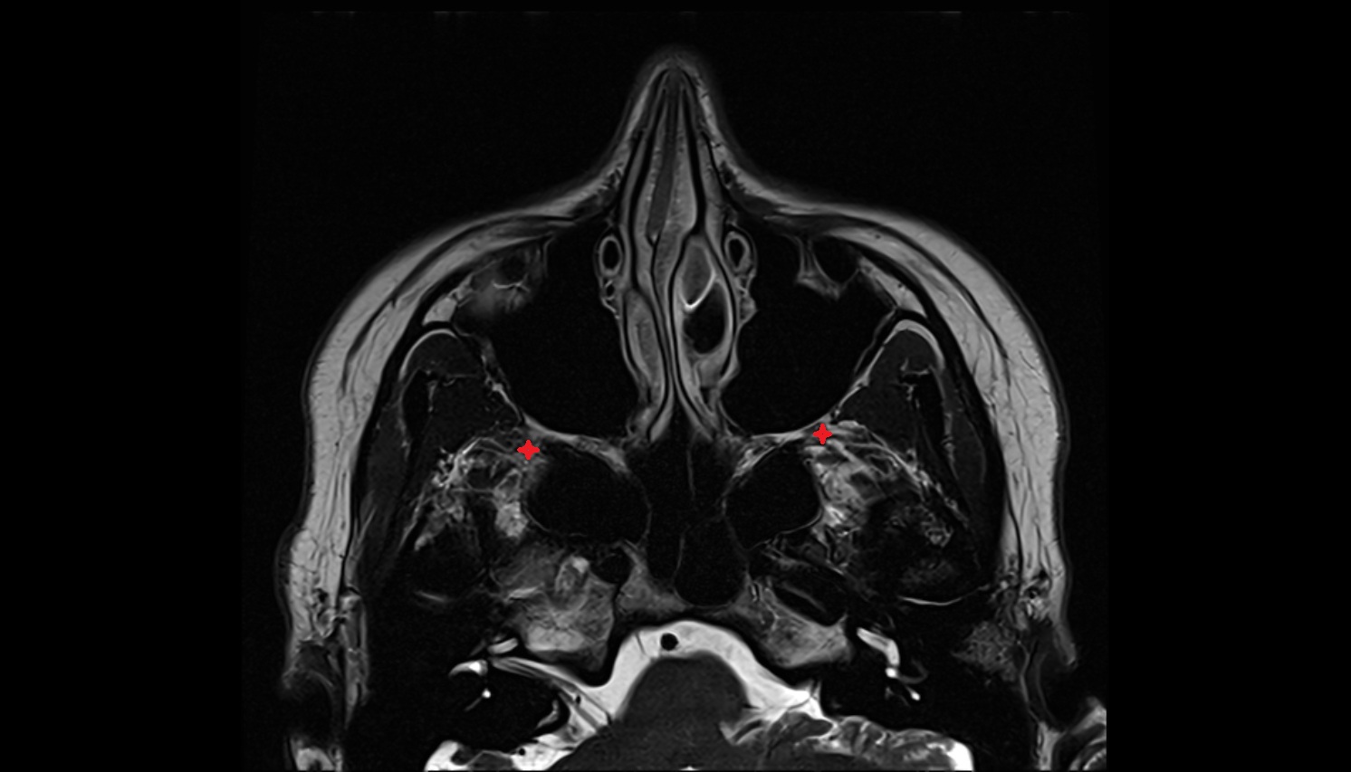 Greater wing of sphenoid bone  mri axial  image -img-00000-00000