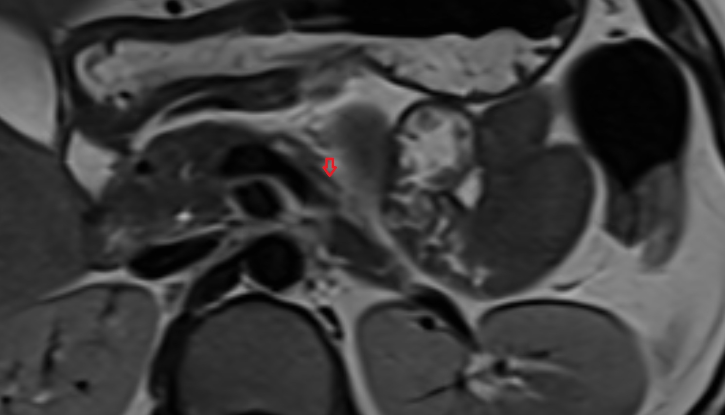 Great pancreatic vein AXIAL MRI  anatomy  image -img-00000-00000