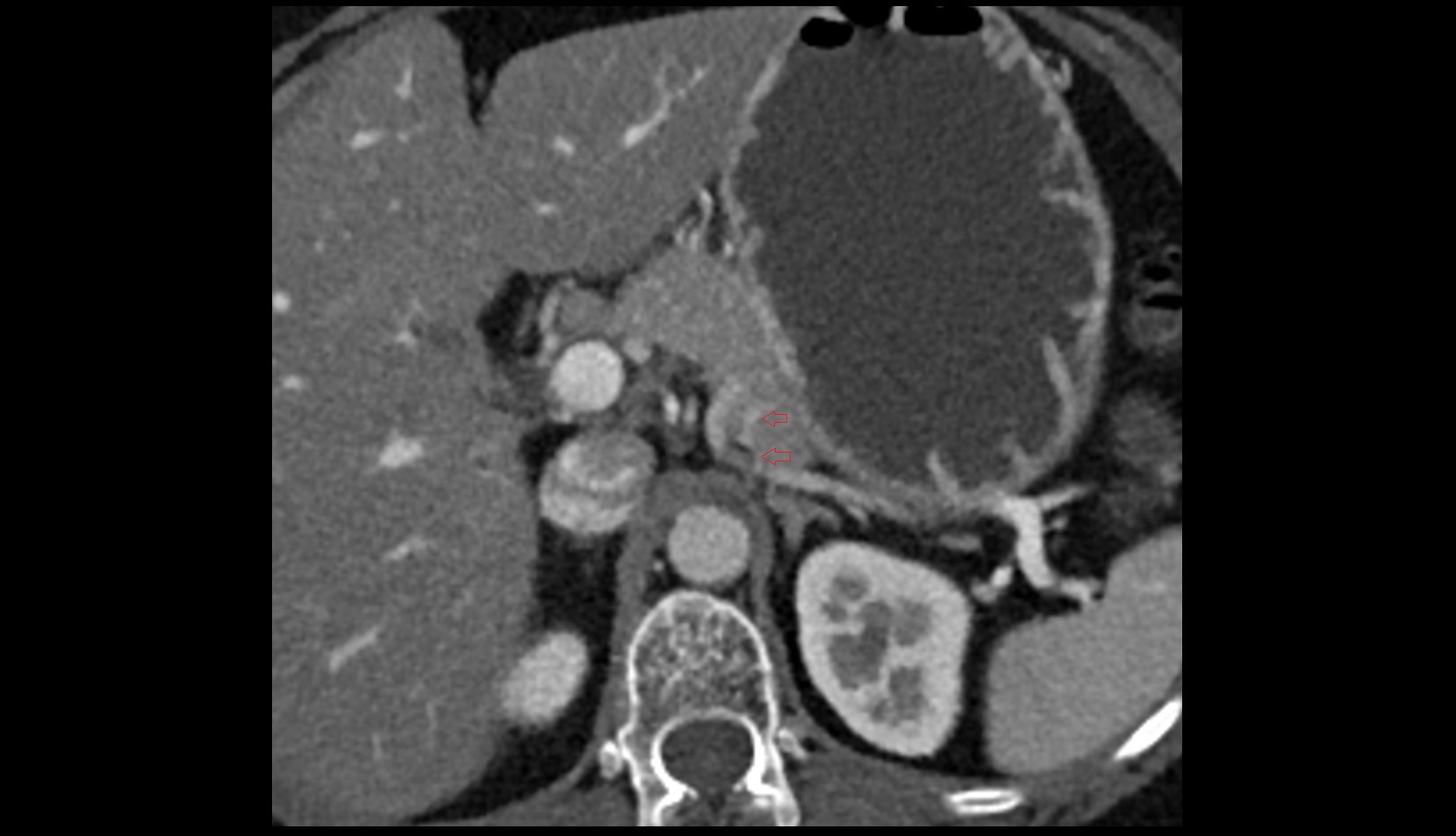 Great pancreatic vein CT AXIAL IMAGE