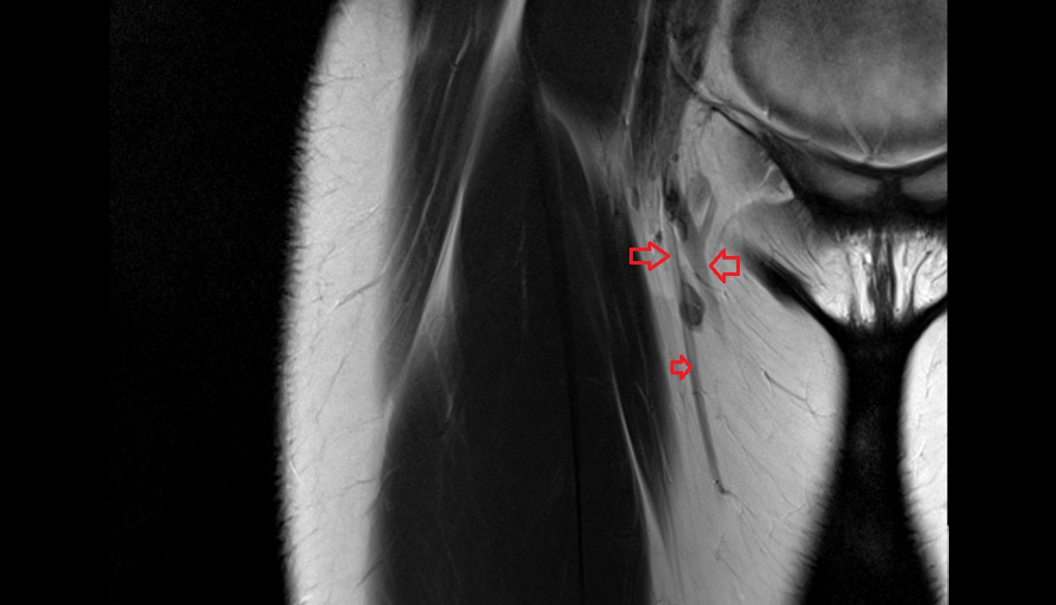 Great saphenous vein MRI coronal   anatomy image-img-00000-00000
