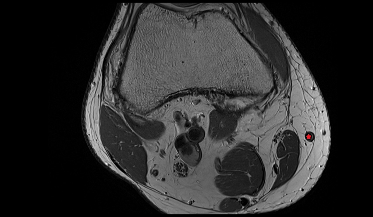 Great saphenous vein anatomy