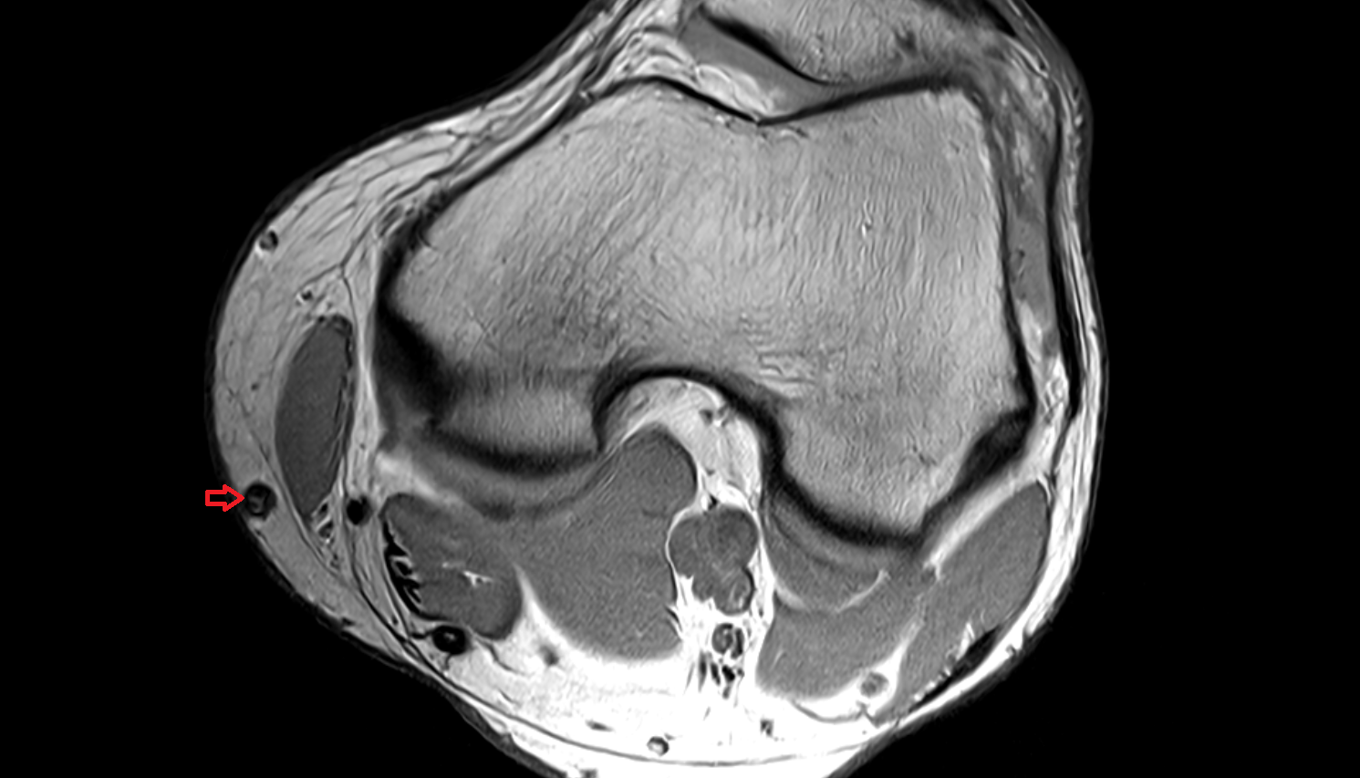 Great saphenous vein  axial  cross sectional anatomy 3T MRI AI enhanced radiology image-img-00000-00000