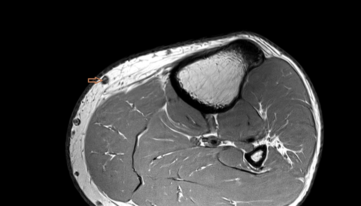 Great saphenous vein  axial  cross sectional anatomy 3T MRI AI enhanced radiology image-img-00000-00000_00001