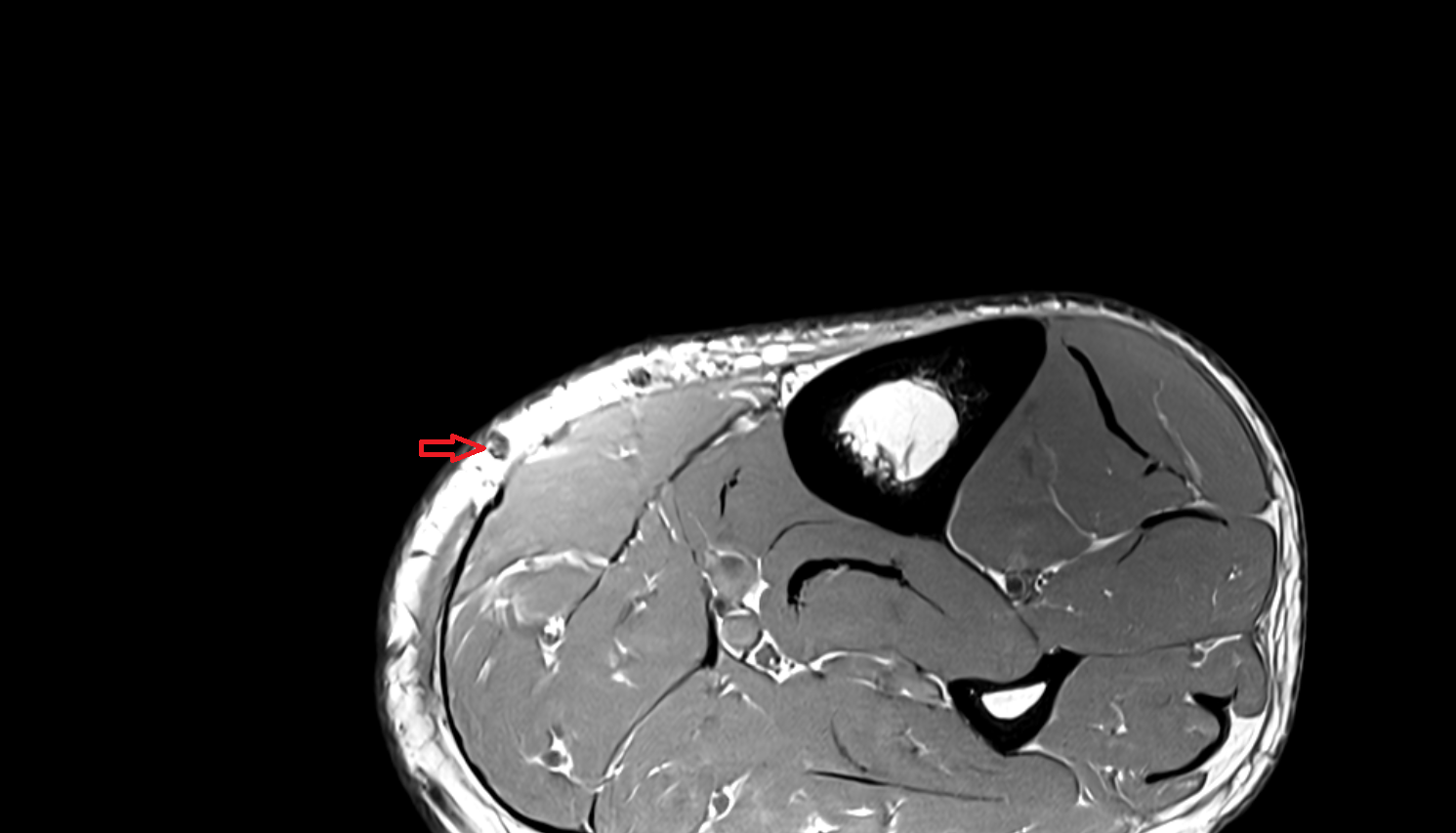 Great saphenous vein  axial  cross sectional anatomy 3T MRI AI enhanced radiology image-img-00000-00000_00002