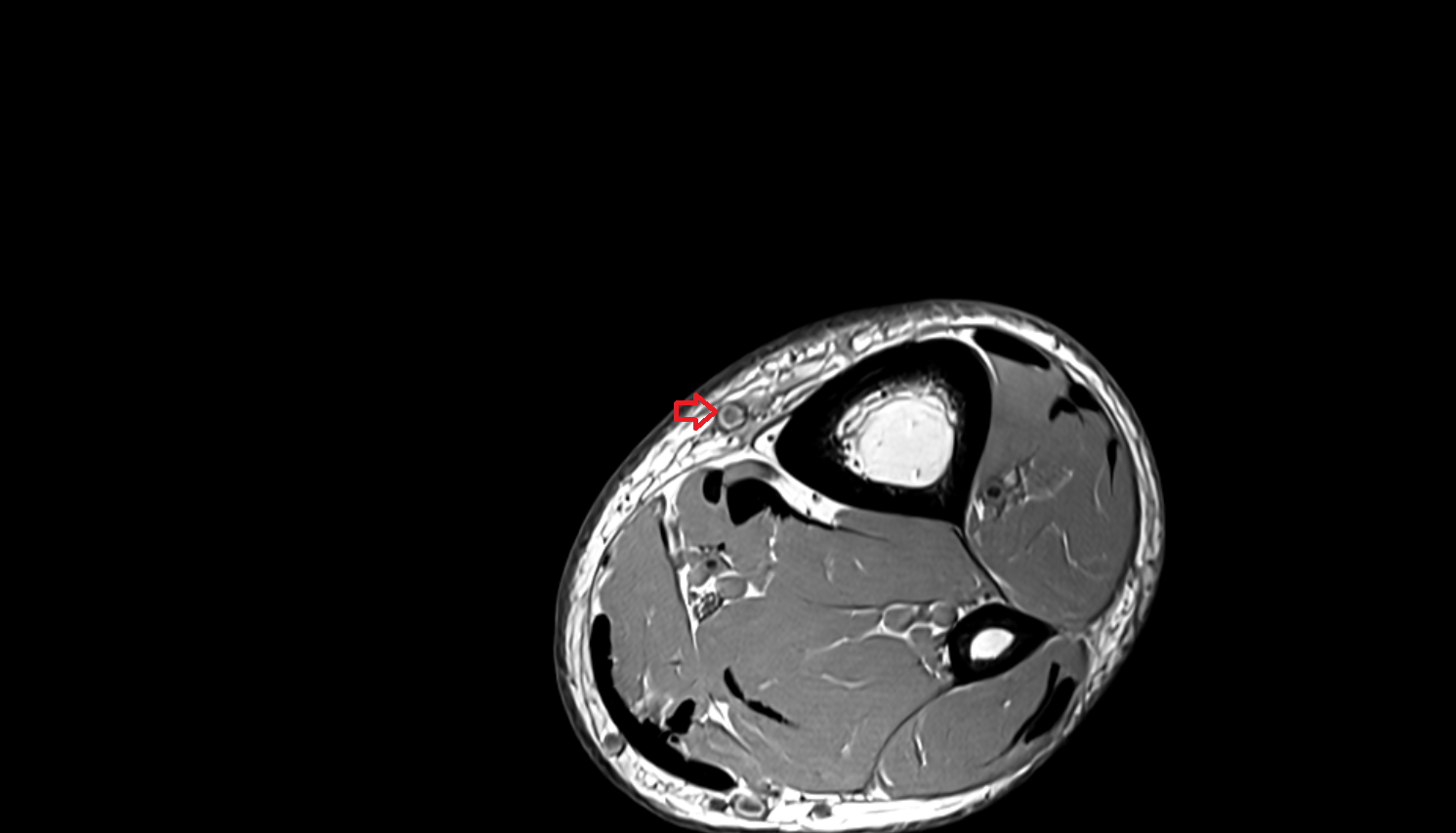 Great saphenous vein  axial  cross sectional anatomy 3T MRI AI enhanced radiology image-img-00000-00000_00003