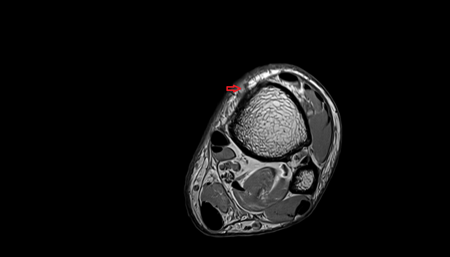Great saphenous vein  axial  cross sectional anatomy 3T MRI AI enhanced radiology image-img-00000-00000_00004