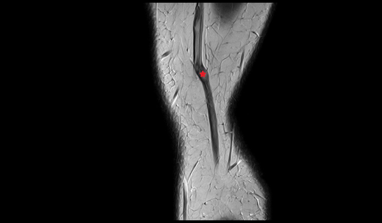 Great saphenous vein cross sectional anatomy mri 3t image