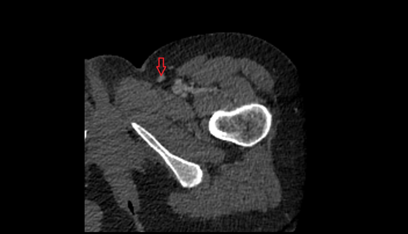 Great saphenous vein ct axial