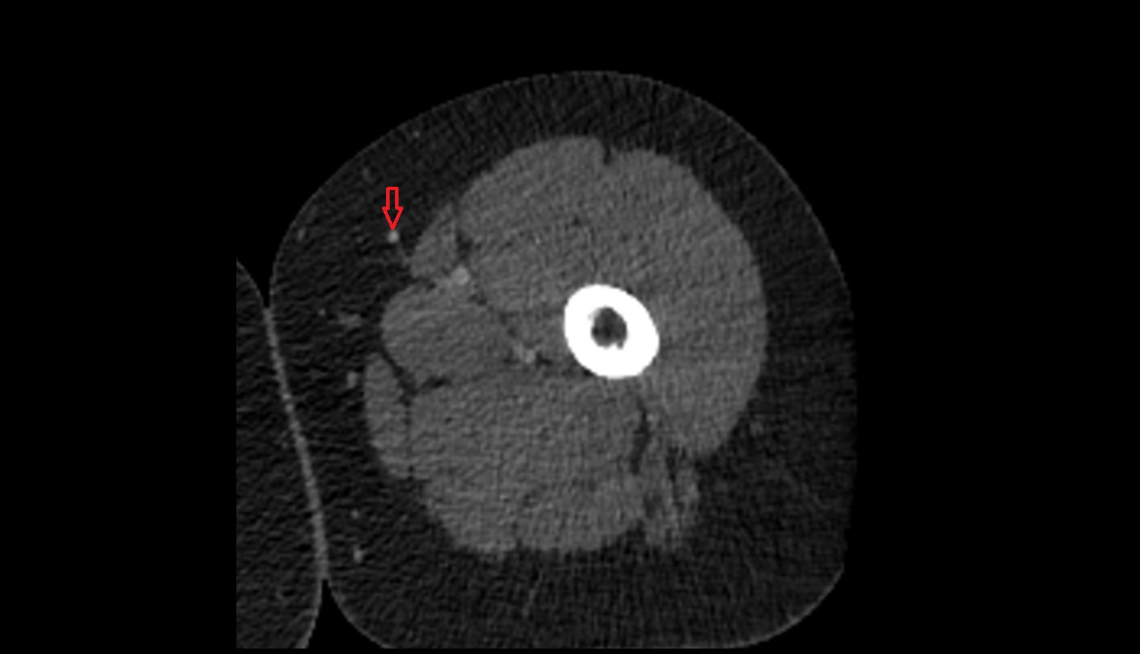 Great saphenous vein ct axial 1