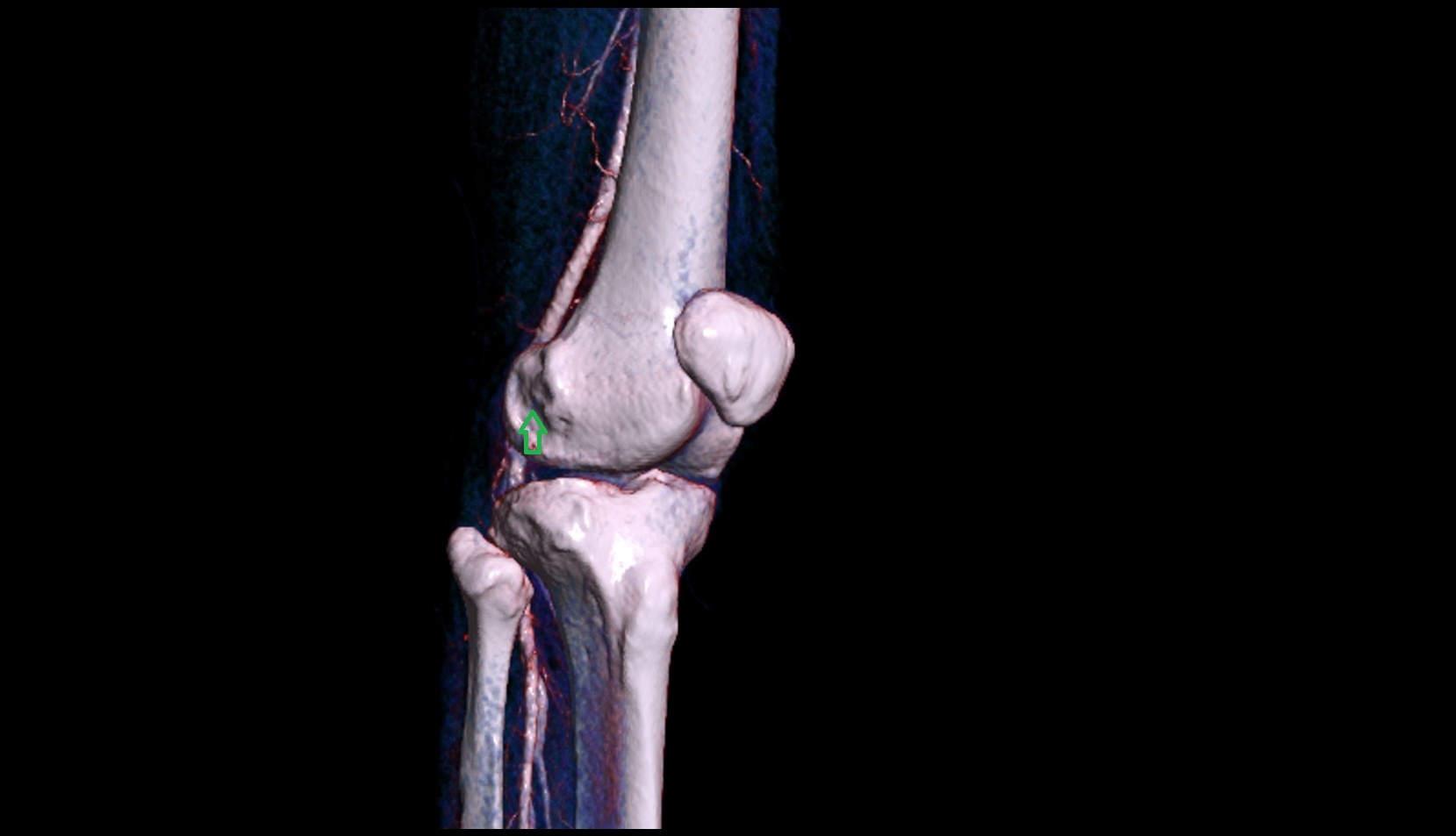 Groove for popliteus muscle ct 3d