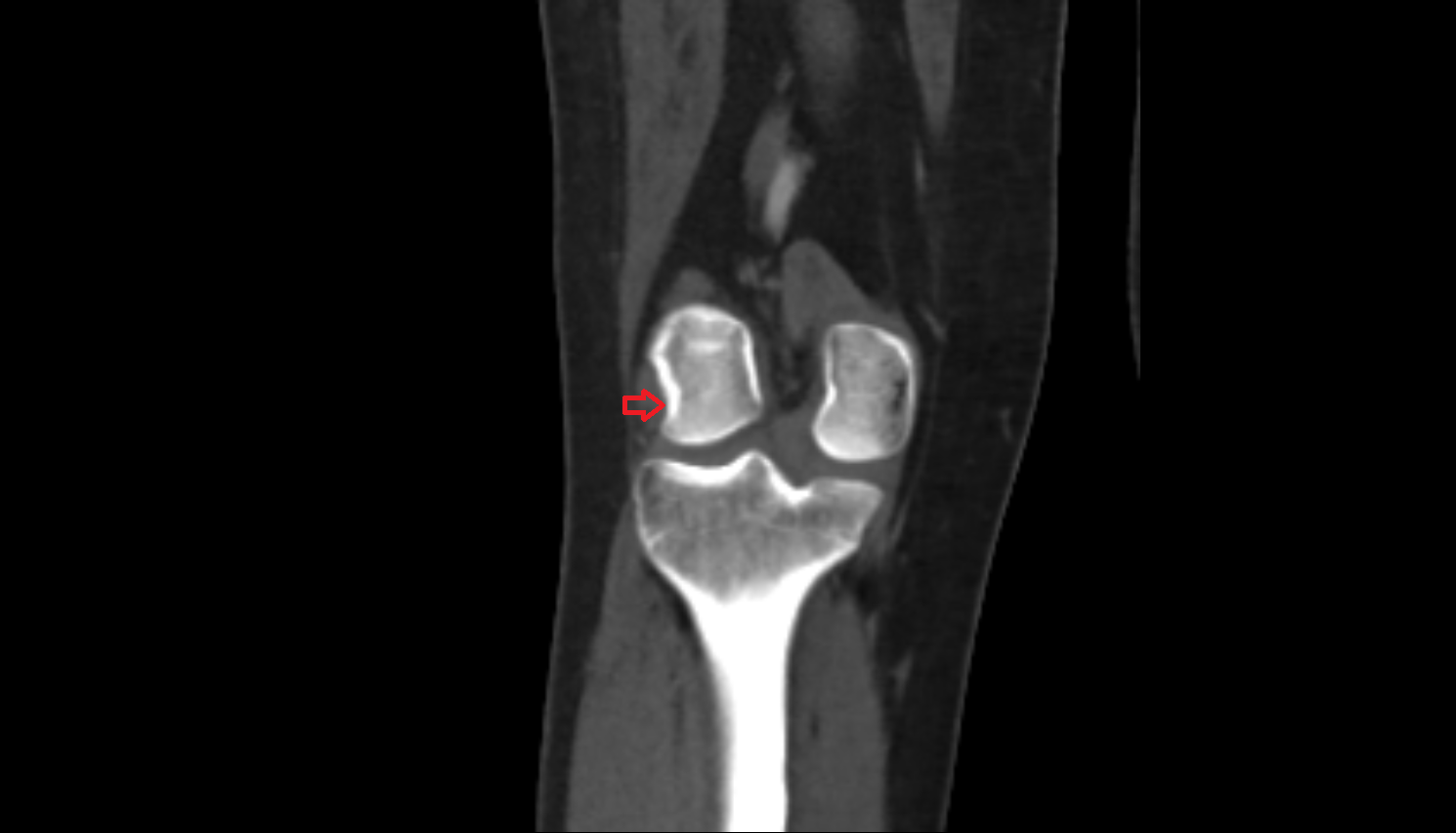 Groove for popliteus muscle  ct anatomy labelled image-img-00000-00000
