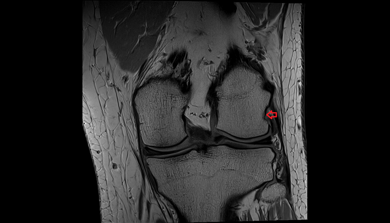 Groove for popliteus muscle  mri anatomy labelled image-img-00000-00000