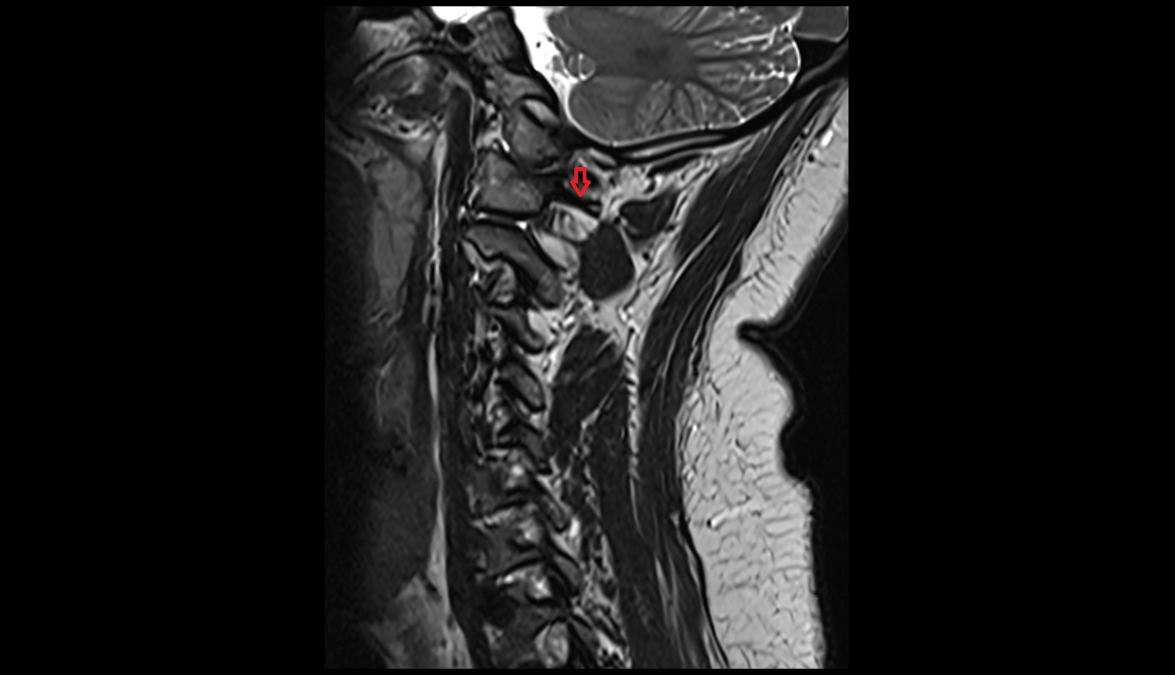 Groove for vertebral artery