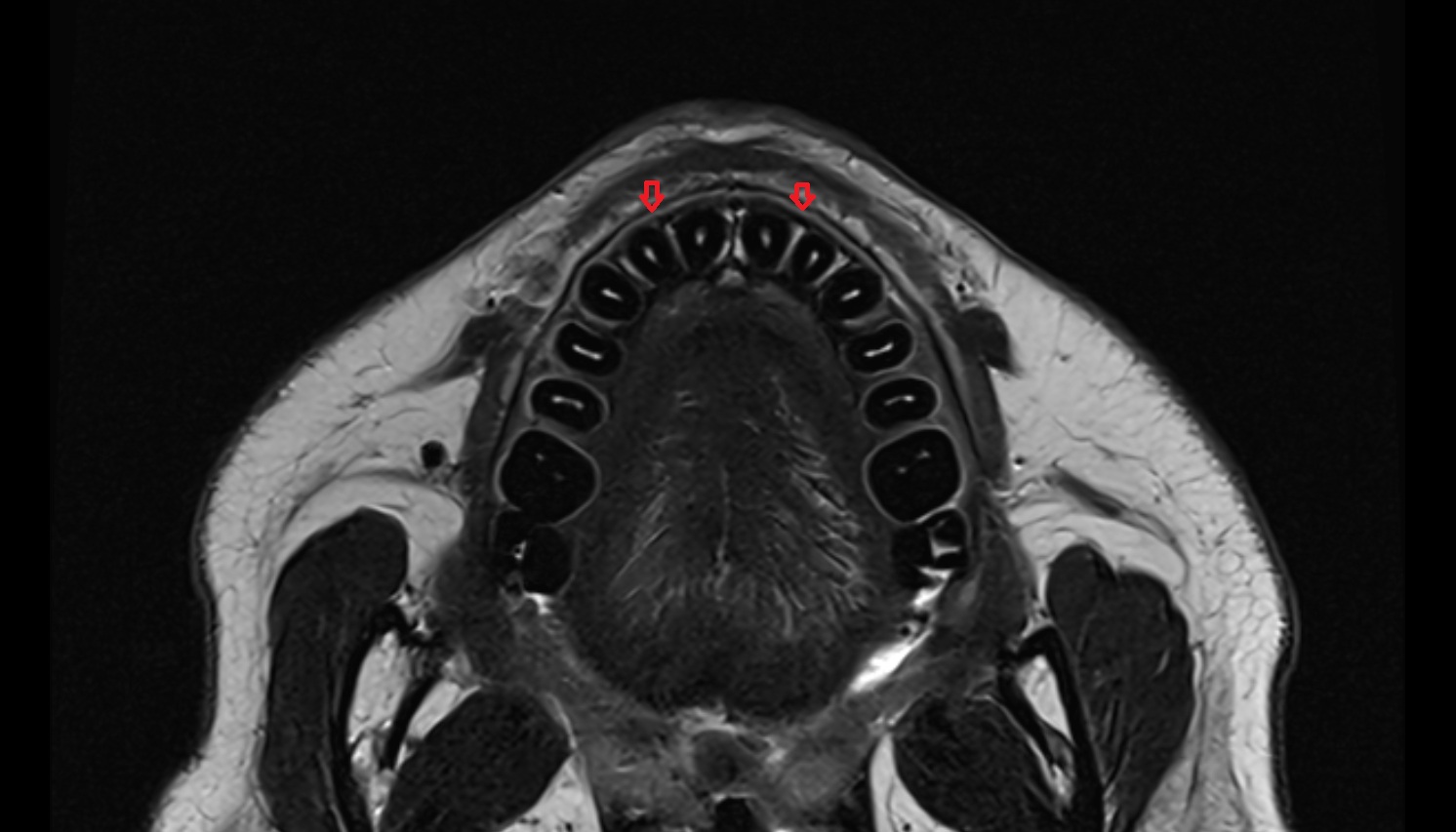 Gum (gingiva)  mri axial image -img-00000-00000