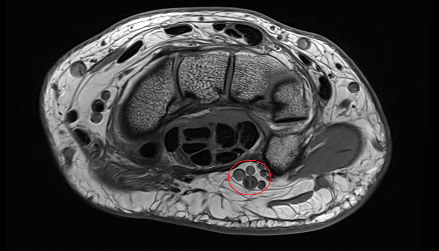 Guyon’s canal axial cross sectional anatomy 3T MRI AI enhanced radiology image-img-00000-00000