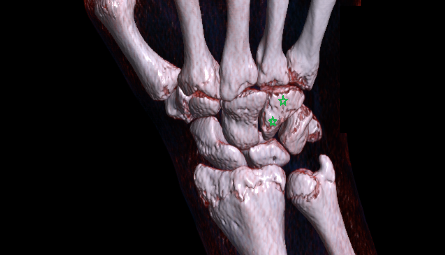 Hamate bone CT 3D VRT image -img-00000-00000